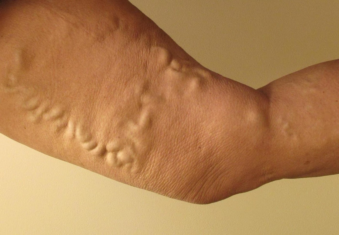 Poate un picior să fie semănat în varicoză, Exerciții pentru vene varicoase - Articole - April
