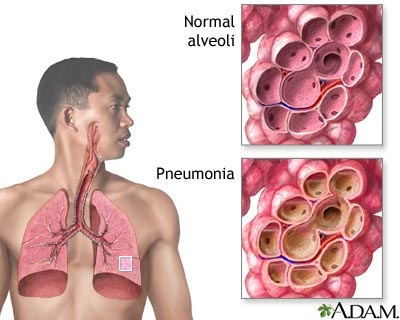 dureri articulare cu pneumococ