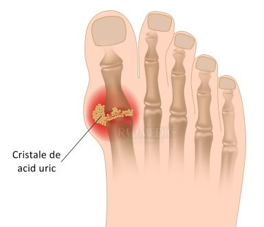 artrita guta a degetului mare