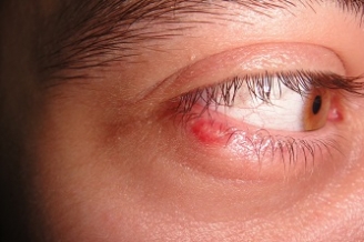 infectii oculare