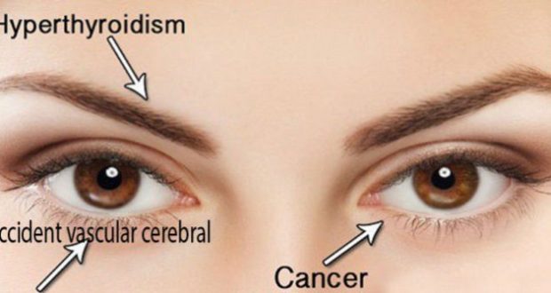 cum se poate vindeca vederea ochilor